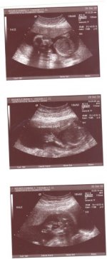 kyle ultrasound 12-26-03.jpg